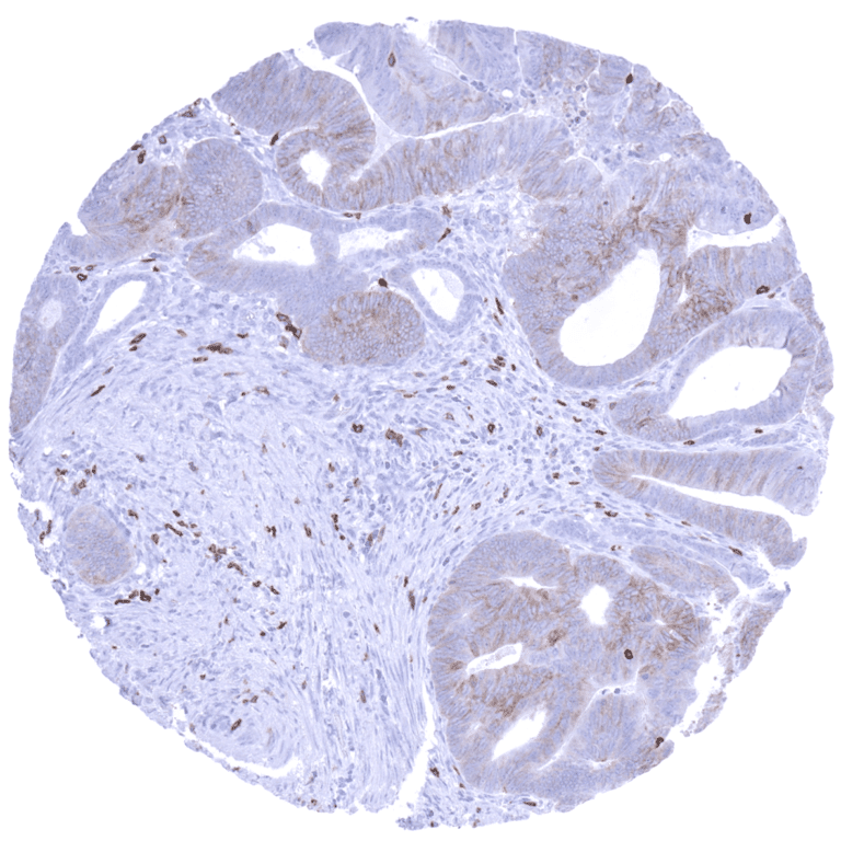 Cancer Tissue Gallery CD5 - MS Validated Antibodies