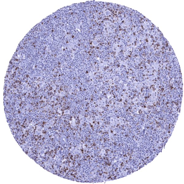 Lymph node- Hodgkin’s lymphoma containing numerous reactive CTLA-4 positive lymphocytes.
