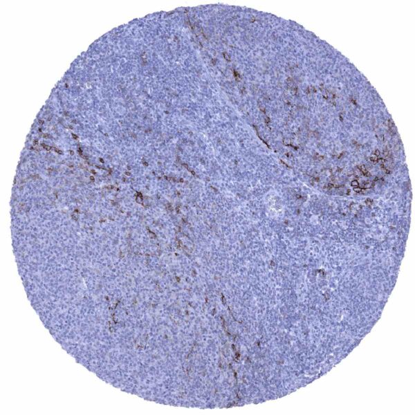 Cd23 Positive Cancer Tissue Gallery CD23 - MS Validated Antibodies