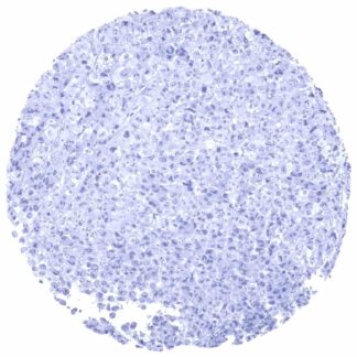 Cd23 Positive Cancer Tissue Gallery CD23 - MS Validated Antibodies