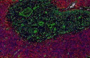 A high Ki67+ proliferation rate (red) is seen in cortical thymocytes. Thymic epithelial cells are shown in green (CKpan+)