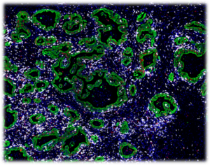 CD8+ cytotoxic T-cells (white) are adjacent to the colorectal cancer cell (green) that show a variable fraction of proliferating cells (Ki67, red)