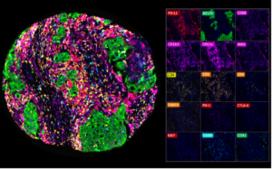 Mulitplex fluorescence IHC analysis of various immune cell types in a colorectal adenocarcinoma